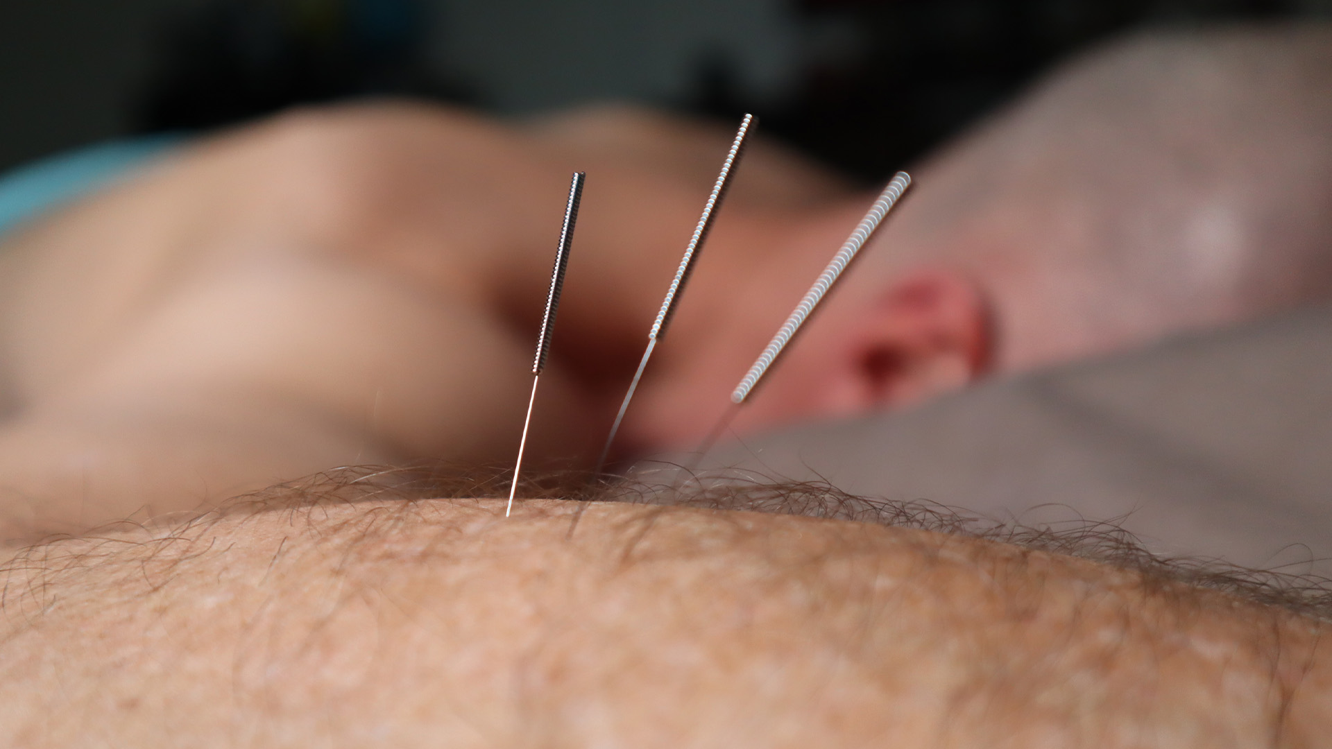 Manage Your Urinary Health with Acupuncture