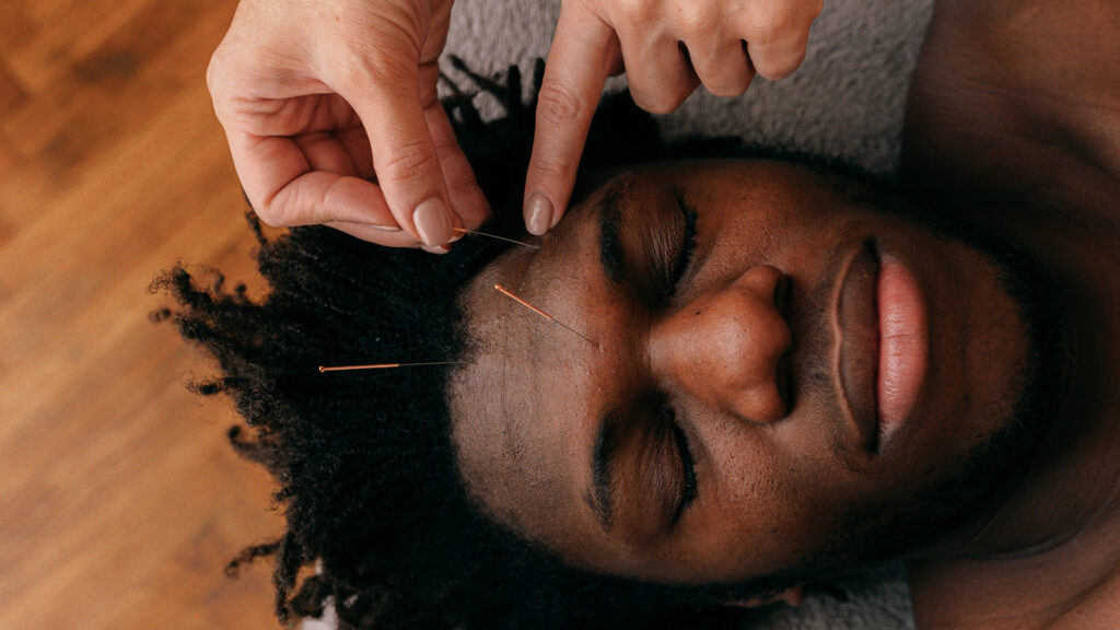 Acupuncture and Headaches Vital Changes