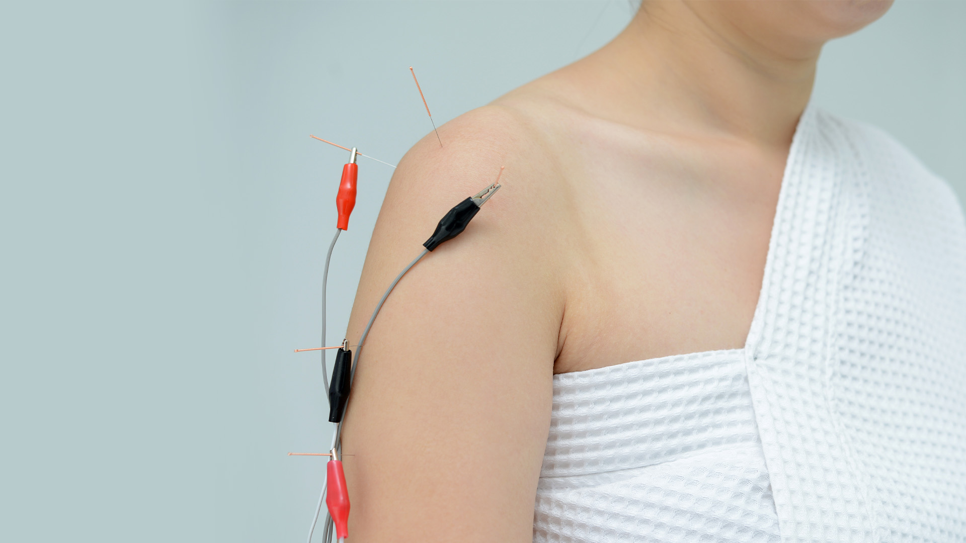 Electrical Stimulation of Acupuncture Needles