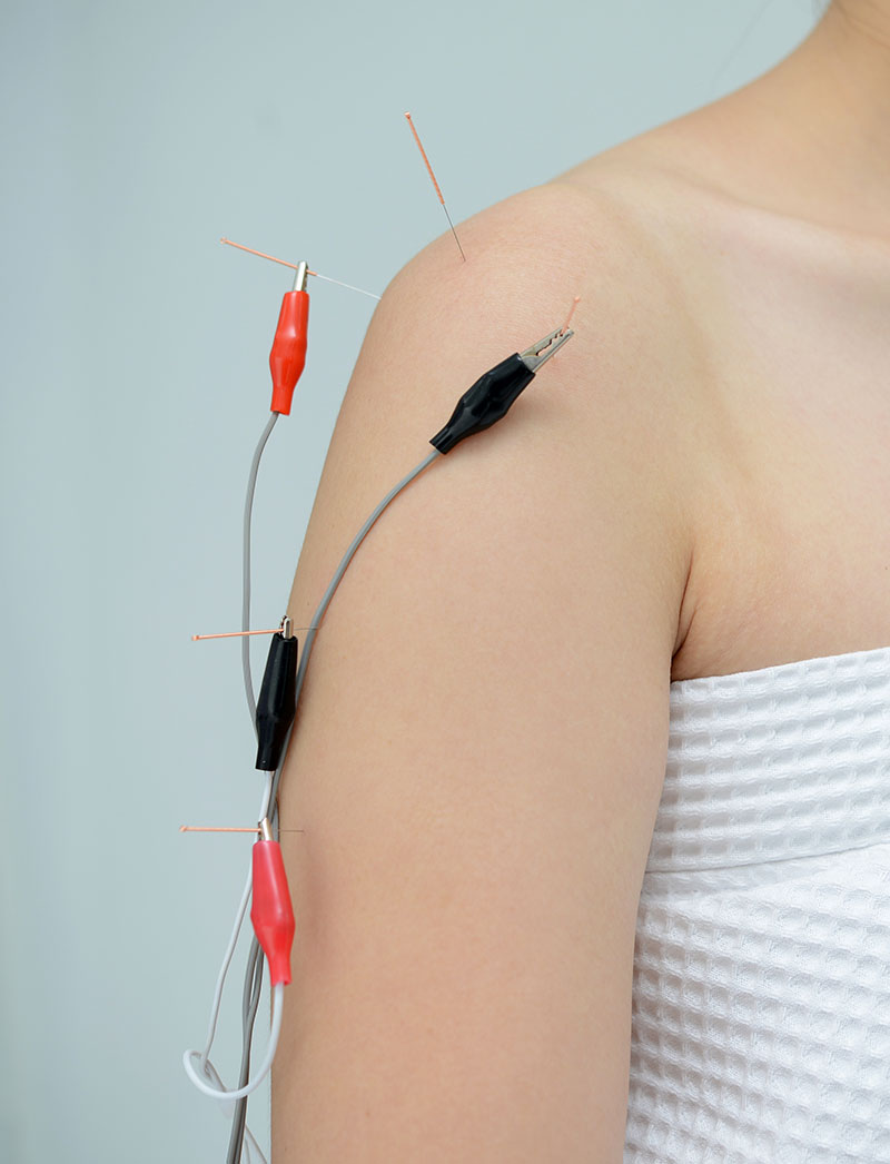 Vital Changes Electro-acupuncture