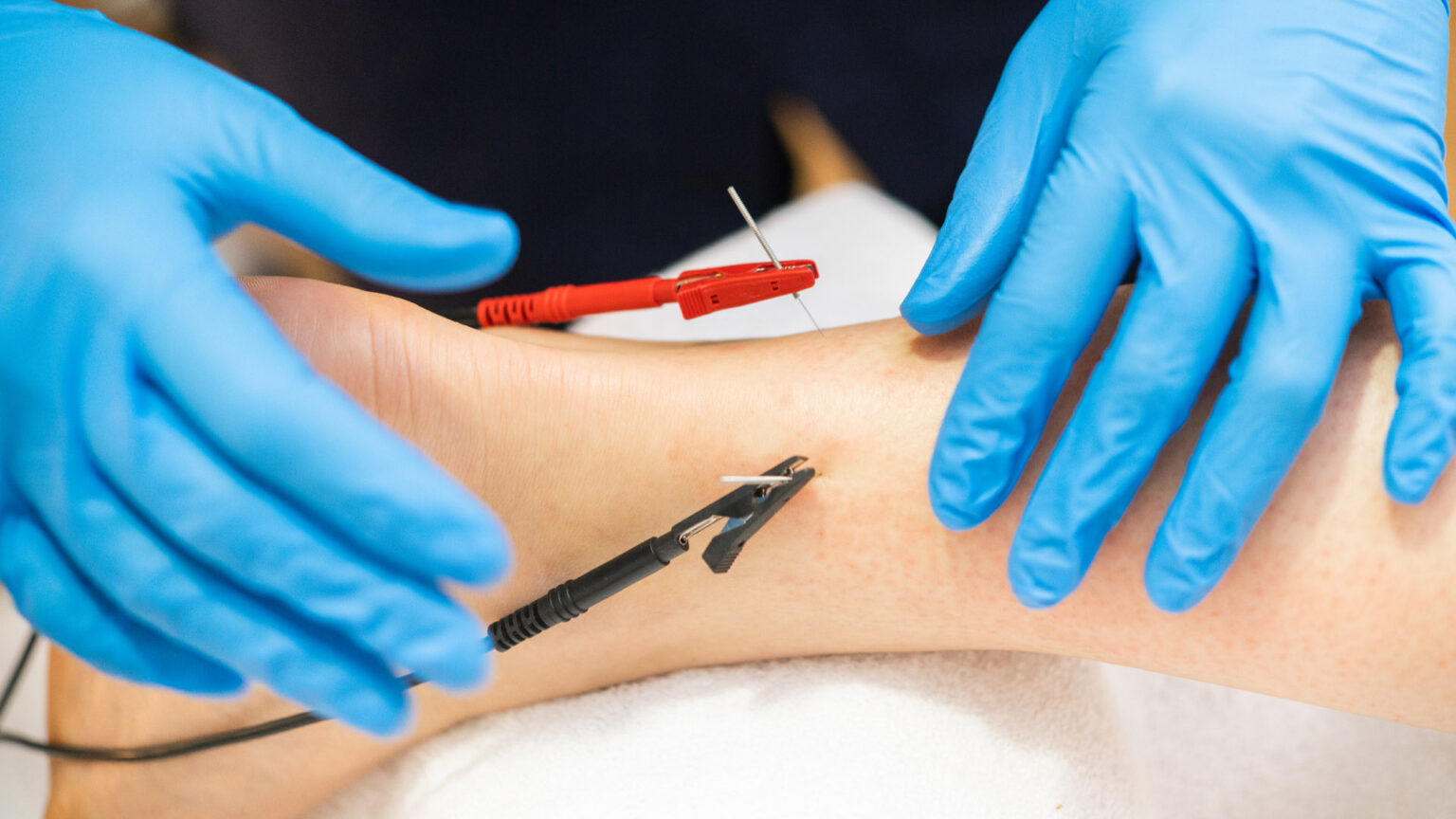 Electroacupuncture Medicine Vital Changes