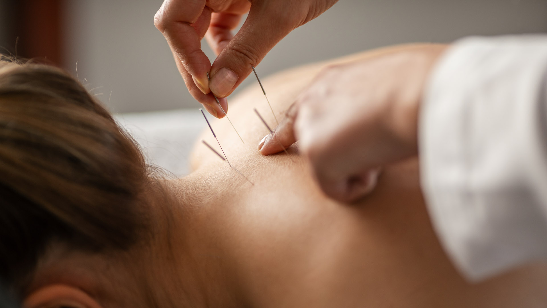 Acupuncture for Post-COVID Syndrome: A Holistic Approach to Recovery