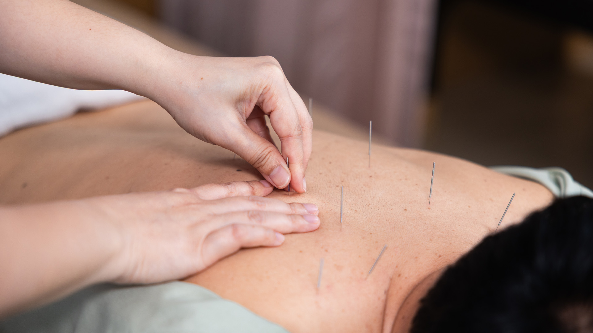 Cigna acupuncture coverage