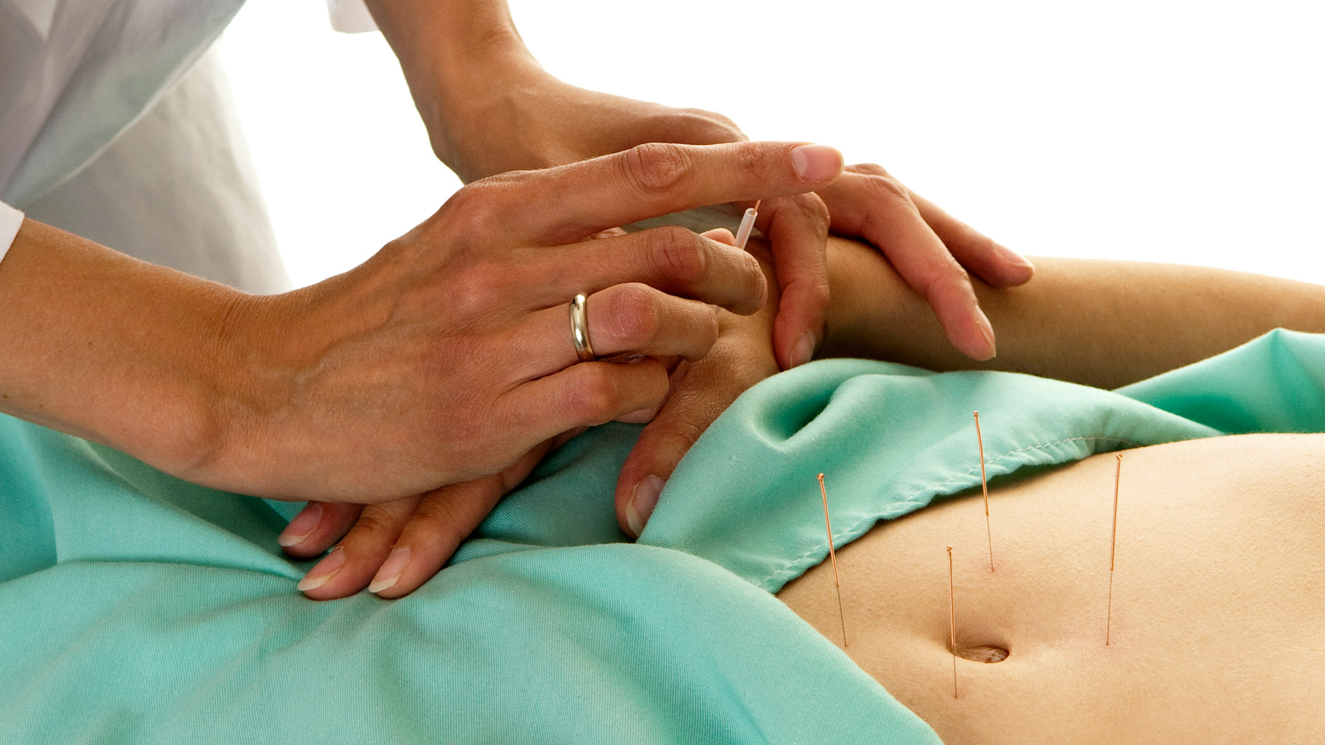 Woman getting acupuncture for fertility.