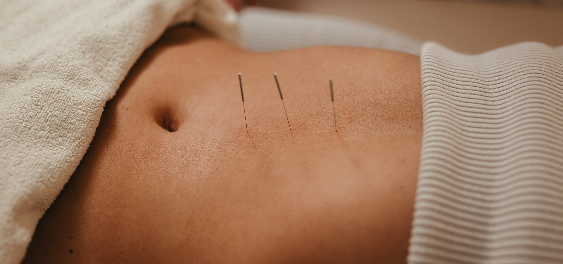Woman laying down on table getting acupuncture for fertility.
